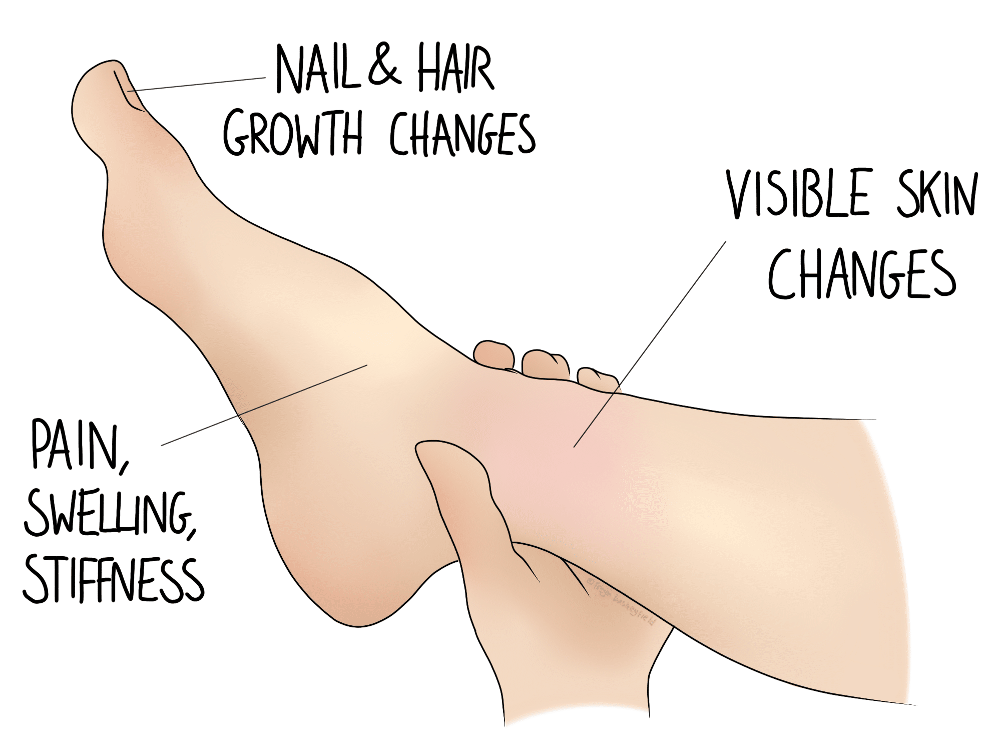 crps-complex-regional-pain-syndrome