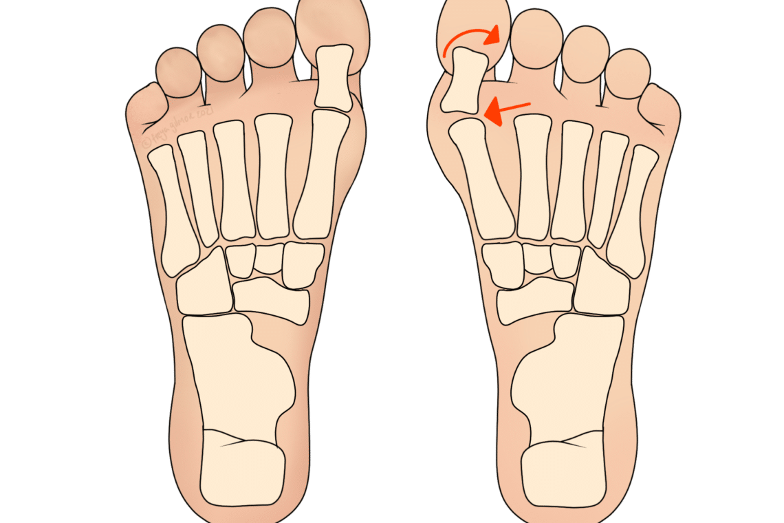 Bunions - Avin Patel Osteopathy & Medical Acupuncture Leicester ...