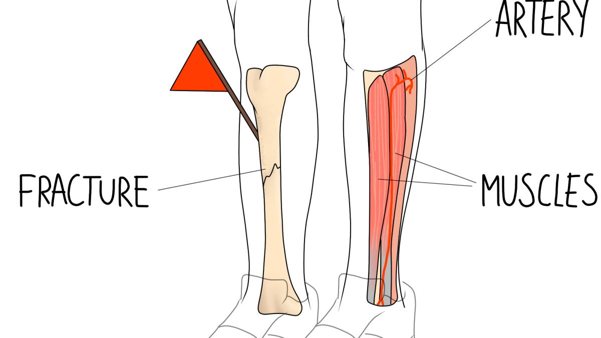 Compartment Syndrome image of legs with artery, fracture and muscles