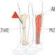 Compartment Syndrome image of legs with artery, fracture and muscles