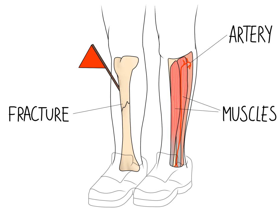 Compartment Syndrome image of legs with artery, fracture and muscles