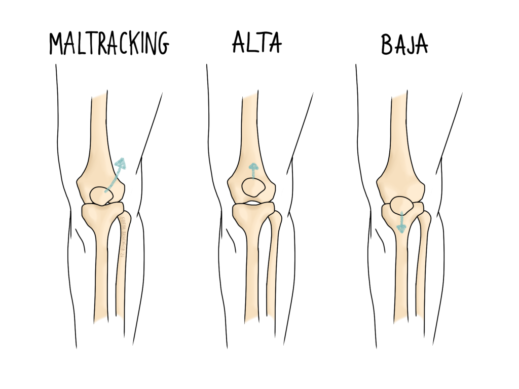 Knee Cap Positional Issues