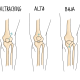 Knee Cap Positional Issues