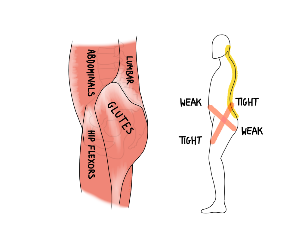 Lower crossed syndrome